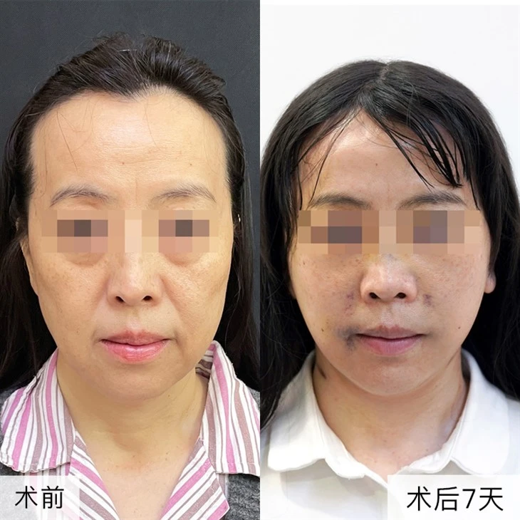 2Facial Sagging Plastic Surgery