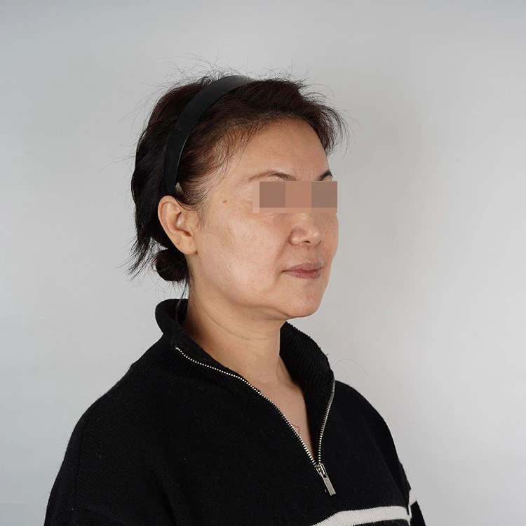 Nasolabial fold filler injection