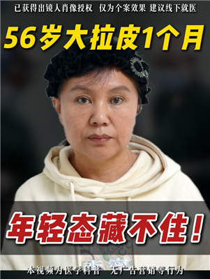 56-Year-Old Age-Defying Miracle: One Month After Full Facelift, Embracing A R...