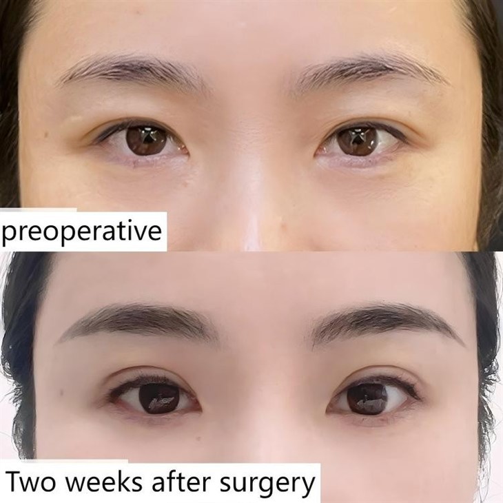 Double Eyelid Restoration