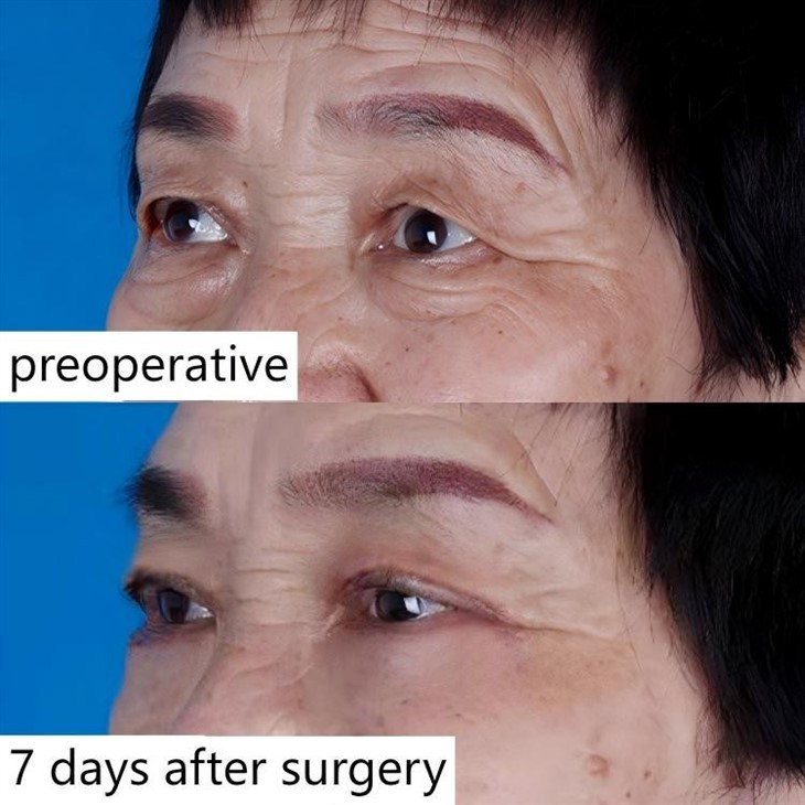 Eye Wrinkle Elimination