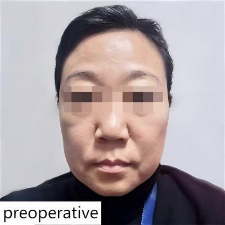 Nasolabial folds improvement method