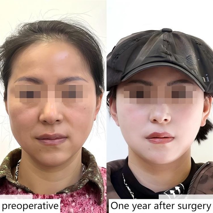 Neck Lift Surgery Neck Lift Surgery