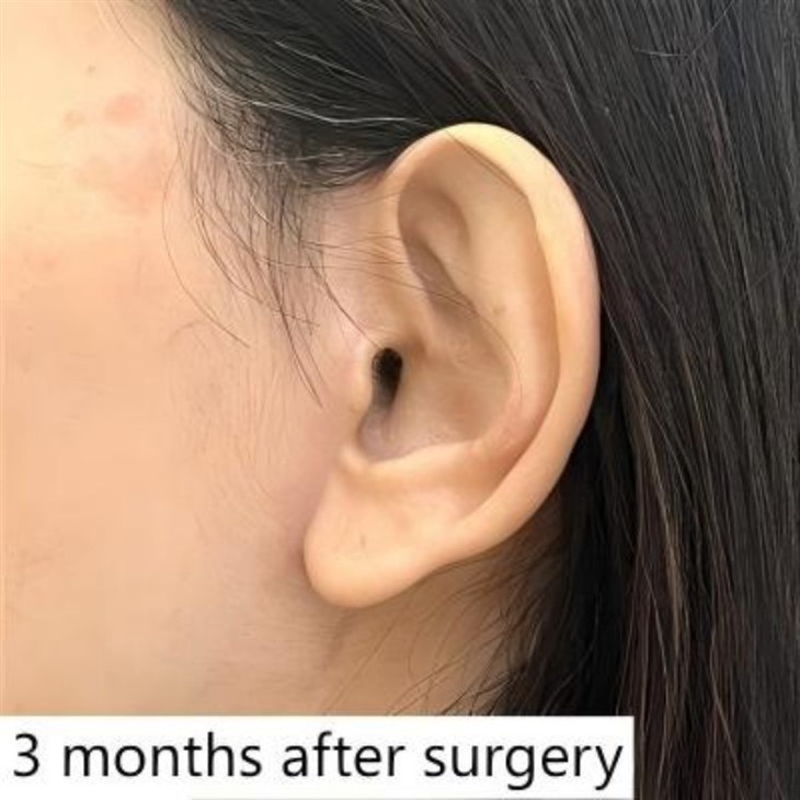 Neck Lift Surgery